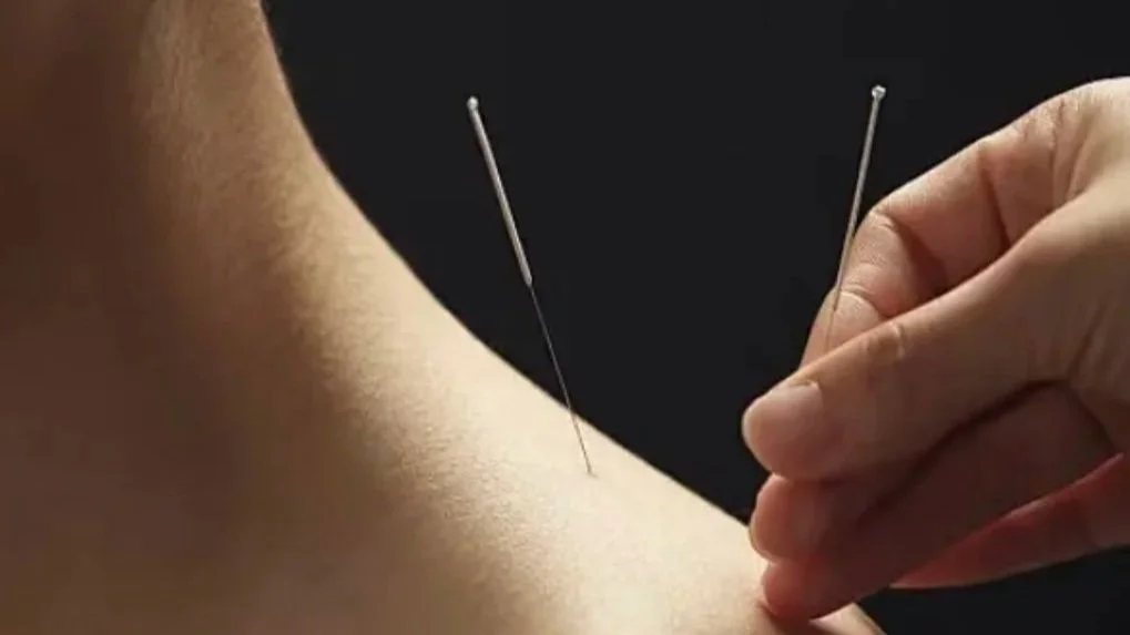 Soothing Dry Needling:born to relieve muscle pain and deep relaxation