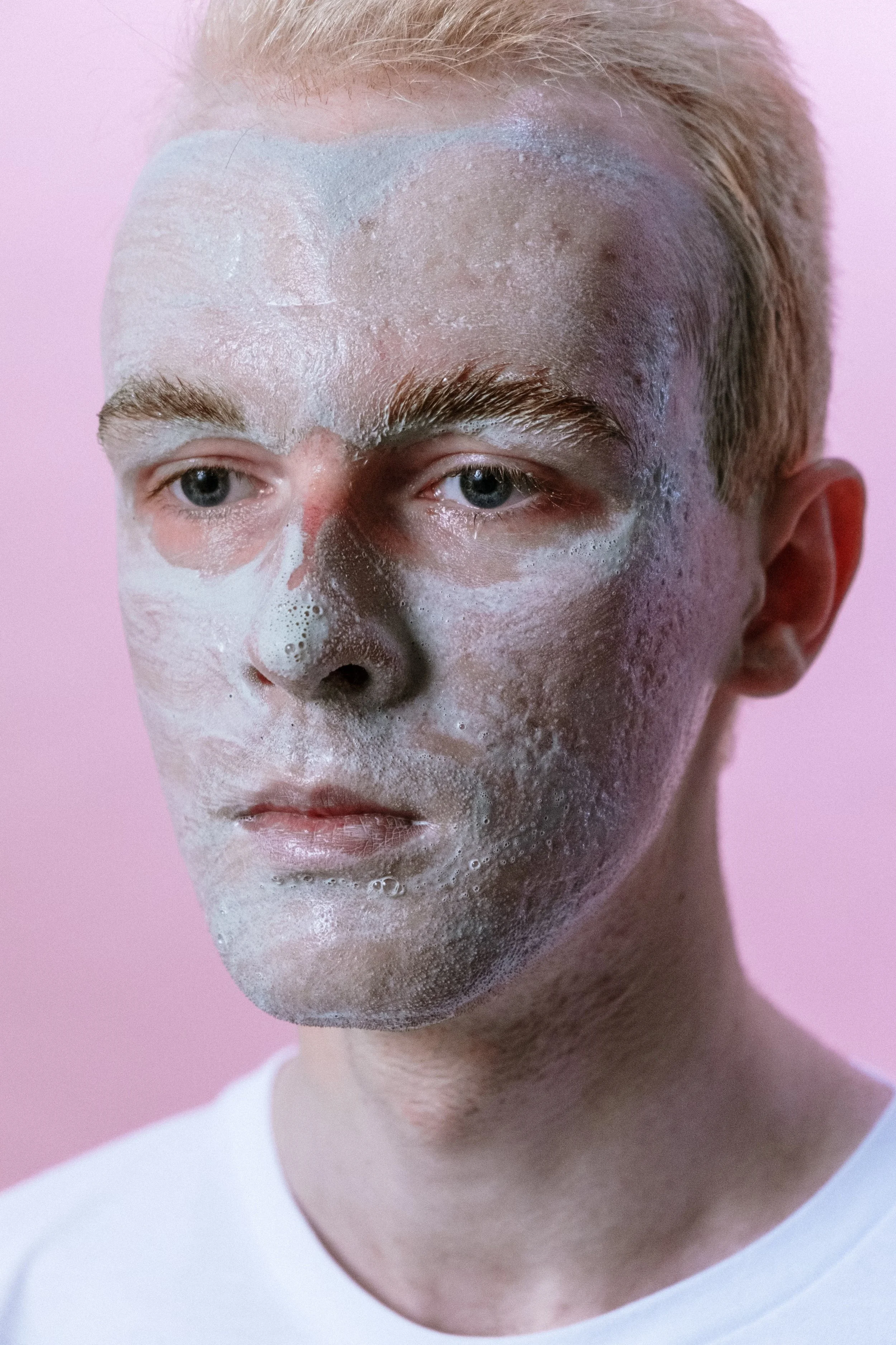 :Professional skincare consultation before an acne facial, with an esthetician evaluating acne-prone skin to recommend the most suitable treatment.