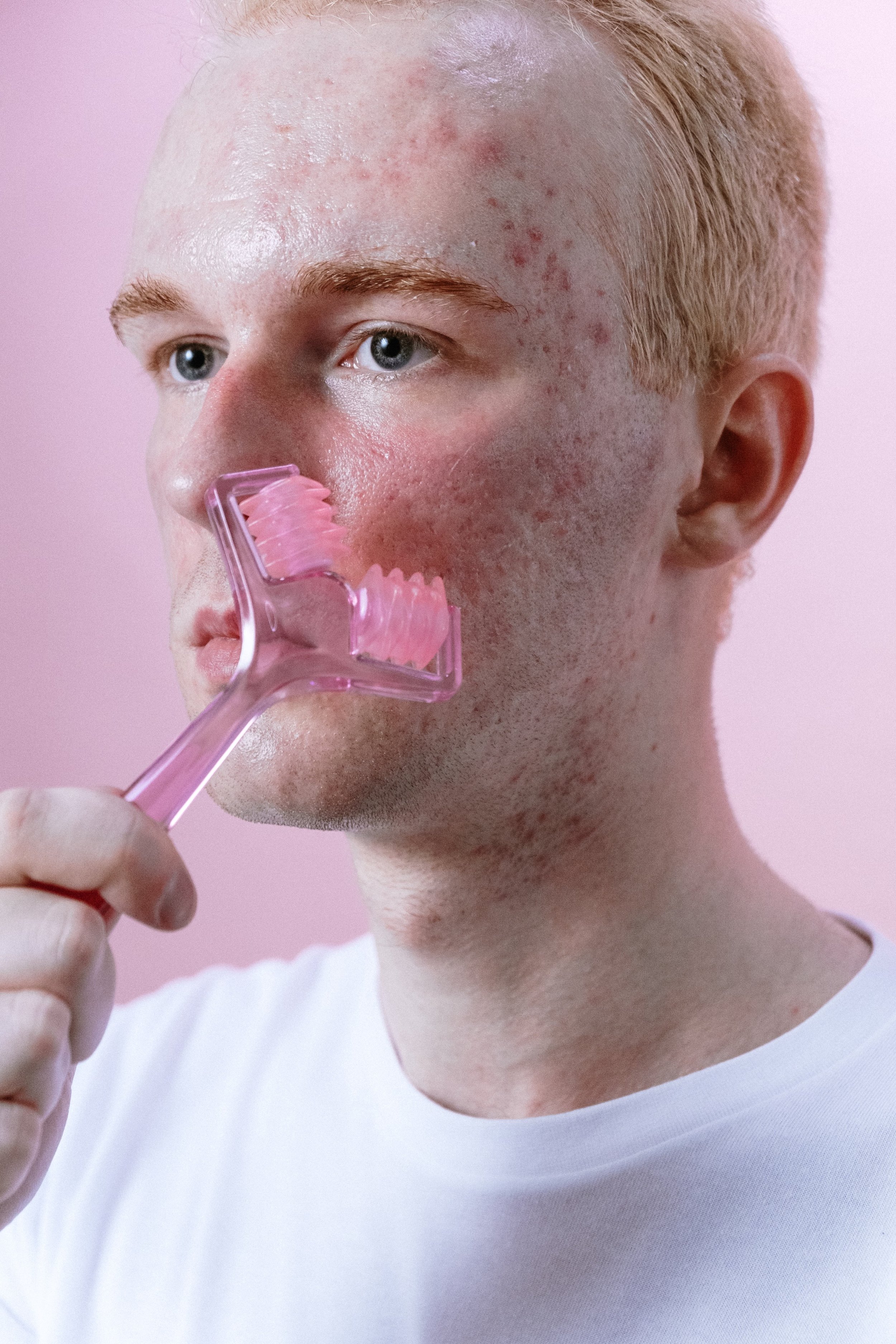 : Professional facial treatment for acne-prone skin, demonstrating deep cleansing and targeted skincare ingredients that help reduce blackheads, pimples, and excess sebum.