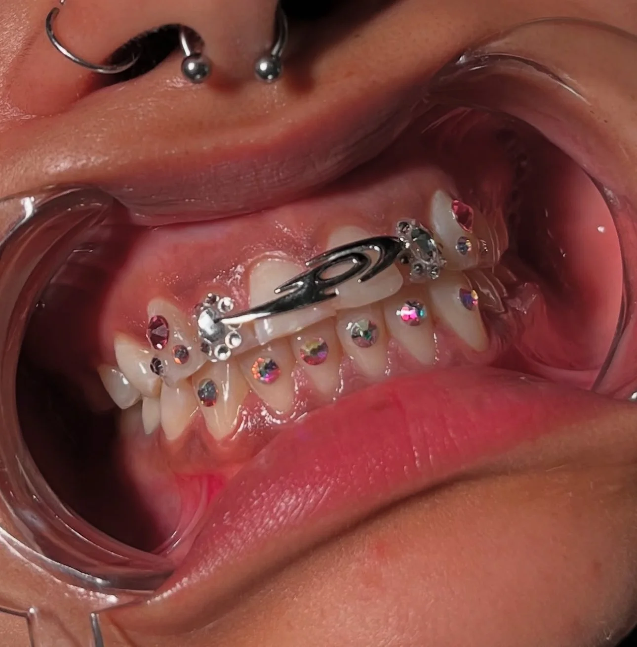 Denti decorati con ciondoli colorati e brillanti, con un piercing sul labbro superiore, vista di una bocca aperta con uno specchio e ferretti per labios
