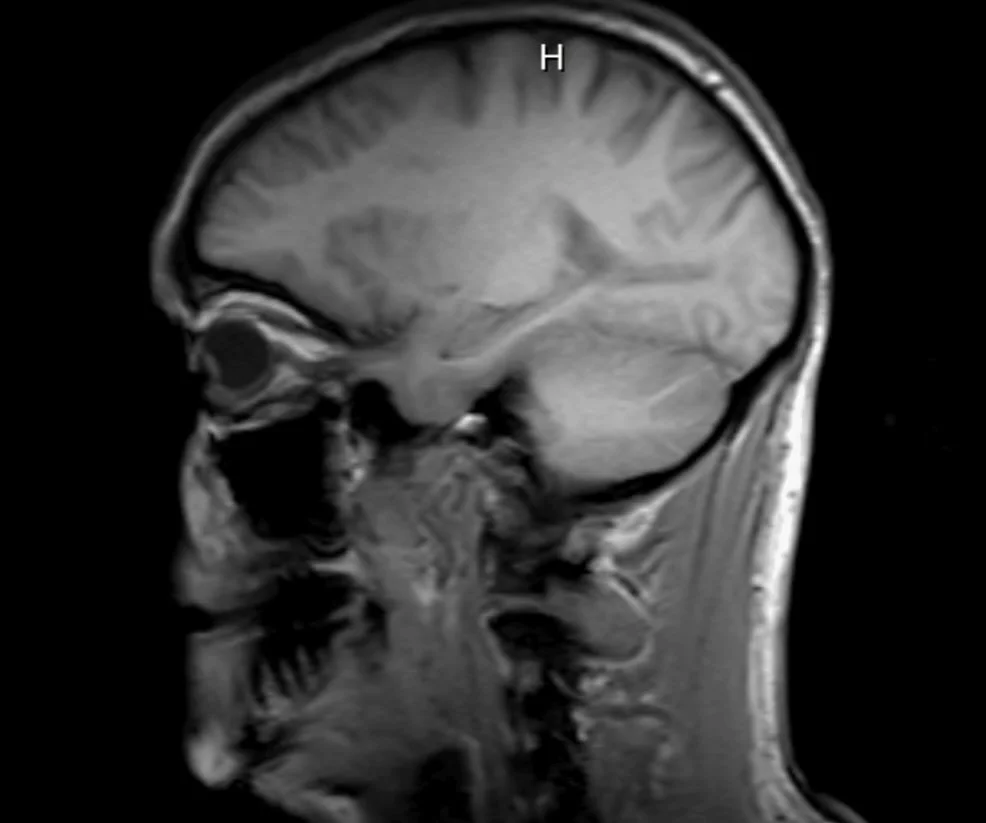 Hemiplegic Migraine (HM) is a rare, severe type of migraine that creates a major medical challenge because its symptoms perfectly mimic a stroke. During an attack, patients experience a migraine headache accompanied by a temporary loss of movement or