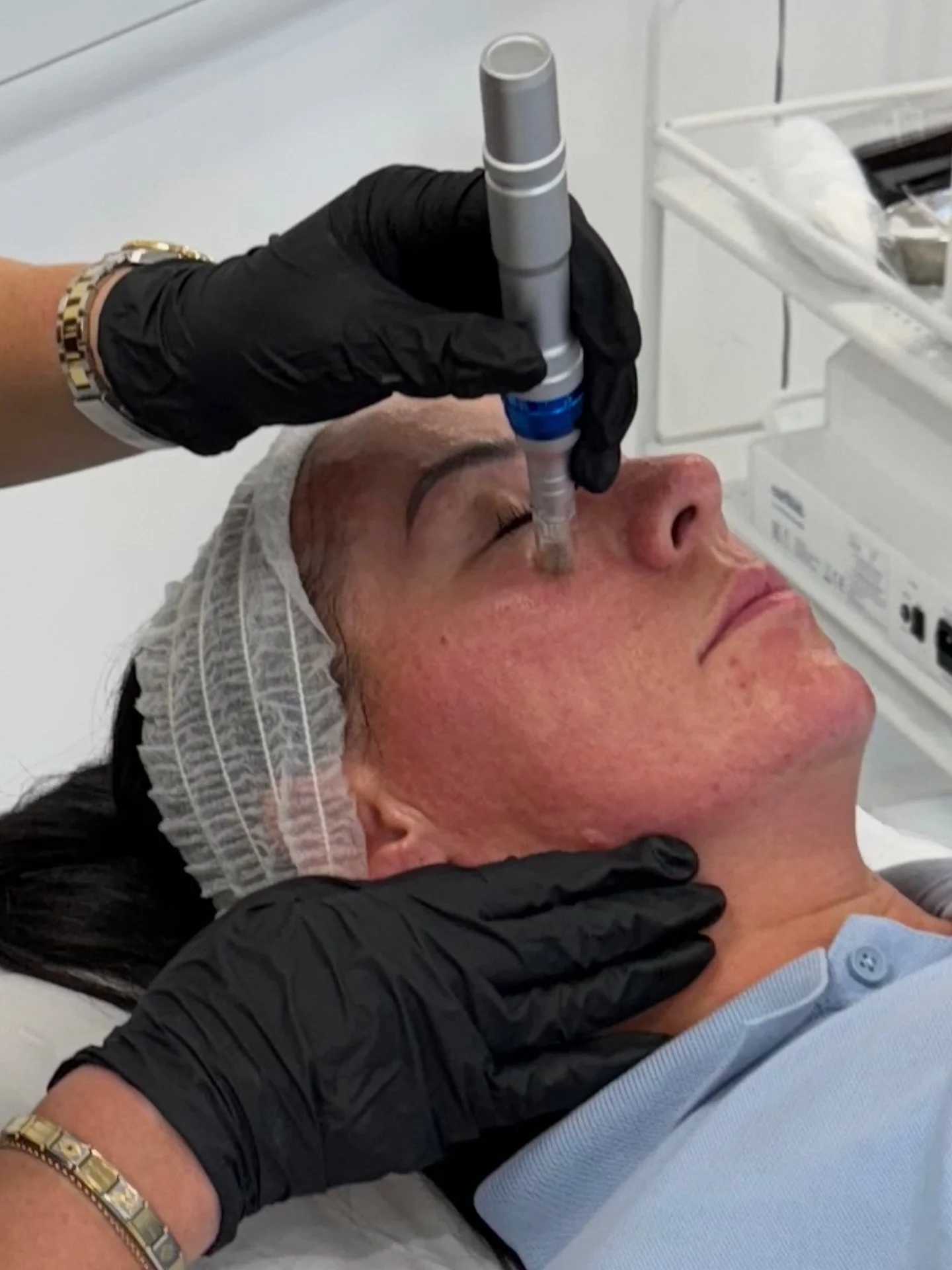 What to expect after micro-needling…
Redness due to the body’s natural response to micro trauma from the fine needles. The increased blood flow helps deliver essential cells & nutrients to aid collagen & elastin production. 
Th