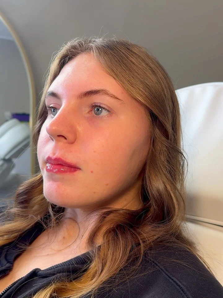 *swipe to see the before*
✨ Lip filler transformation — enhancing shape, restoring volume, and boosting confidence.
Our results are always natural-looking, tailored to your unique features.
💉 Treatment time: 1 hour
⏳ Minimal downtime
📅 Ready