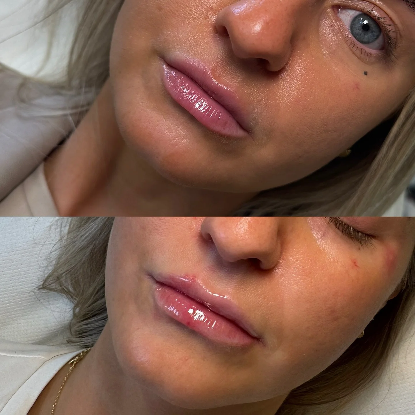 ✨ Soft & Subtle ✨
Before & after of our signature lip filler treatment 
Enhancing natural beauty with fuller, more defined lips while keeping it effortlessly natural.
**swelling & redness present as post treatment**
📍Book your consult