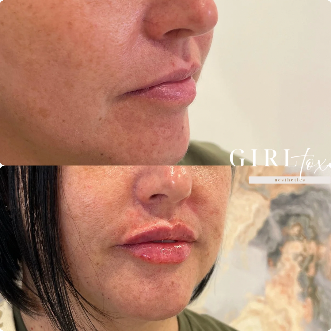 lip filler 