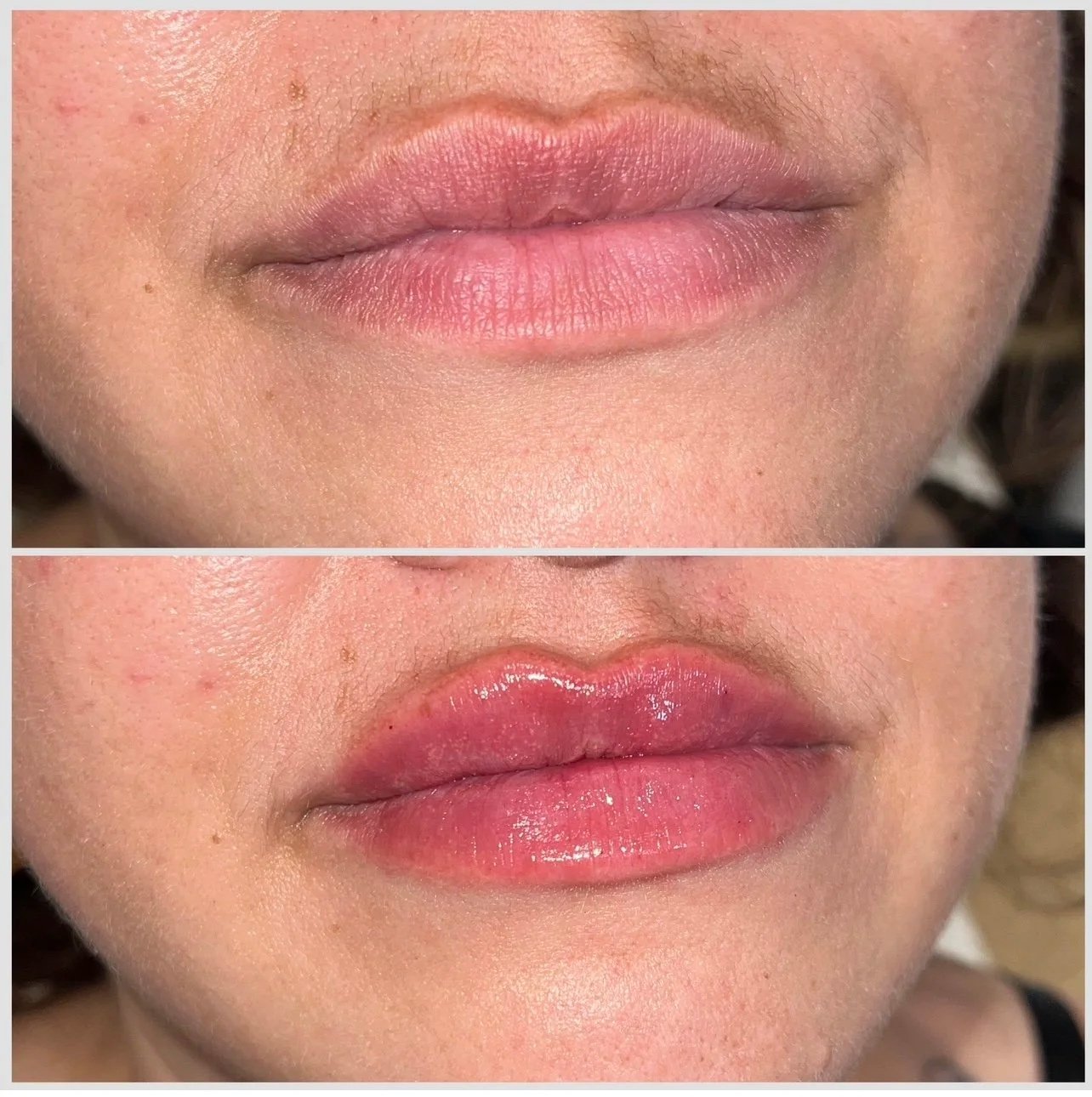 lip filler 