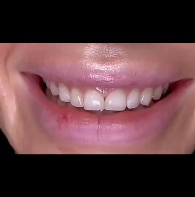 Natural is the new perfect ✨
Our high-translucency veneers are designed to mimic the light and depth of natural enamel — so your smile looks flawless yet completely real.
 #Veneers #CosmeticDentistry #DreamSmile #DentalAesthetics #SmileTransfor