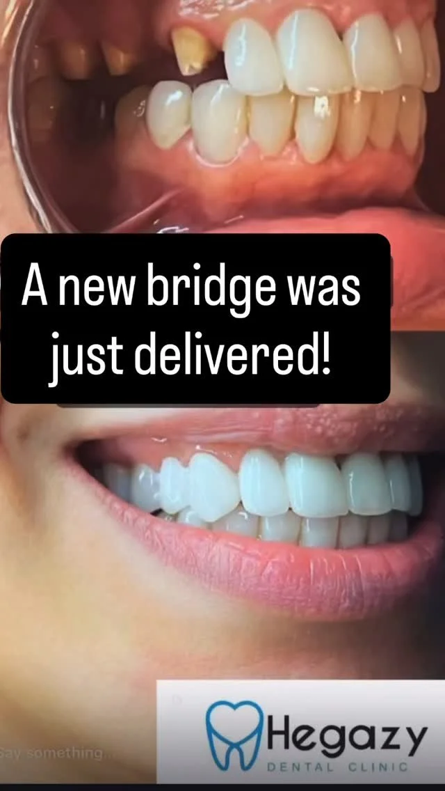 🌟 Got a missing tooth? Don’t worry, we’ve got you covered! 🦷💪
A bridge is like a little teamwork project between your teeth — the ones next to the gap support a brand-new tooth in the middle.
WhatsApp +201123009933
☎️ +2011199943