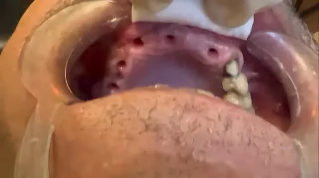 Video 1 (Healing check)
🦷 “Healing was perfect after placing the implants in the upper anterior and the upper right posterior quadrant.”
👉 The implants in the upper left side and the lower arch are still remaining and will be placed in