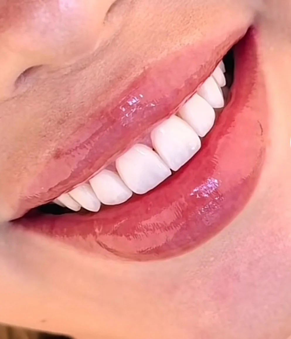 Sarah always dreamed of a brighter, more confident smile but couldn&rsquo;t justify the sky-high prices back home. After a free online consultation, she decided to fly to Cairo for a full veneers makeover. 🇪🇬💎 ✈️ 

#DentalTourism #CairoVibes #Visi