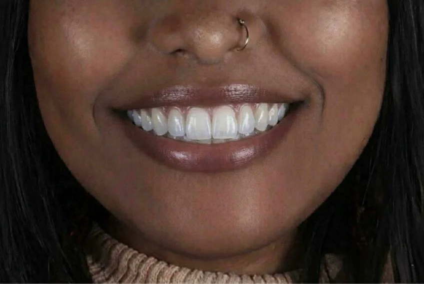 Throwback to our beautiful Farya who flew all the way from the States to Cairo for her dream smile ✨🇺🇸🇪🇬
Natural veneers, confident smile, and memories we&rsquo;ll never forget 🤍

#veneers #dentatourism #cairo #dentist