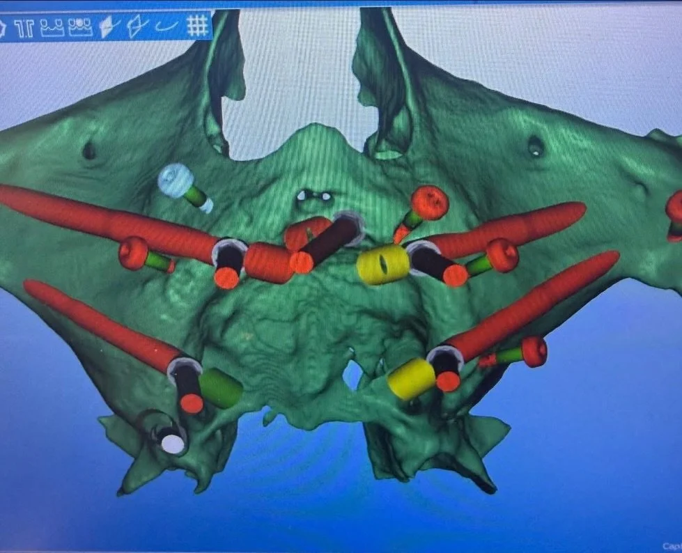 Our patient Jared traveled all the way from Miami to undergo a comprehensive full-mouth rehabilitation surgery, successfully completed at Hegazy Dental Clinic using advanced digital planning and a fully guided surgical approach.

This complex case in