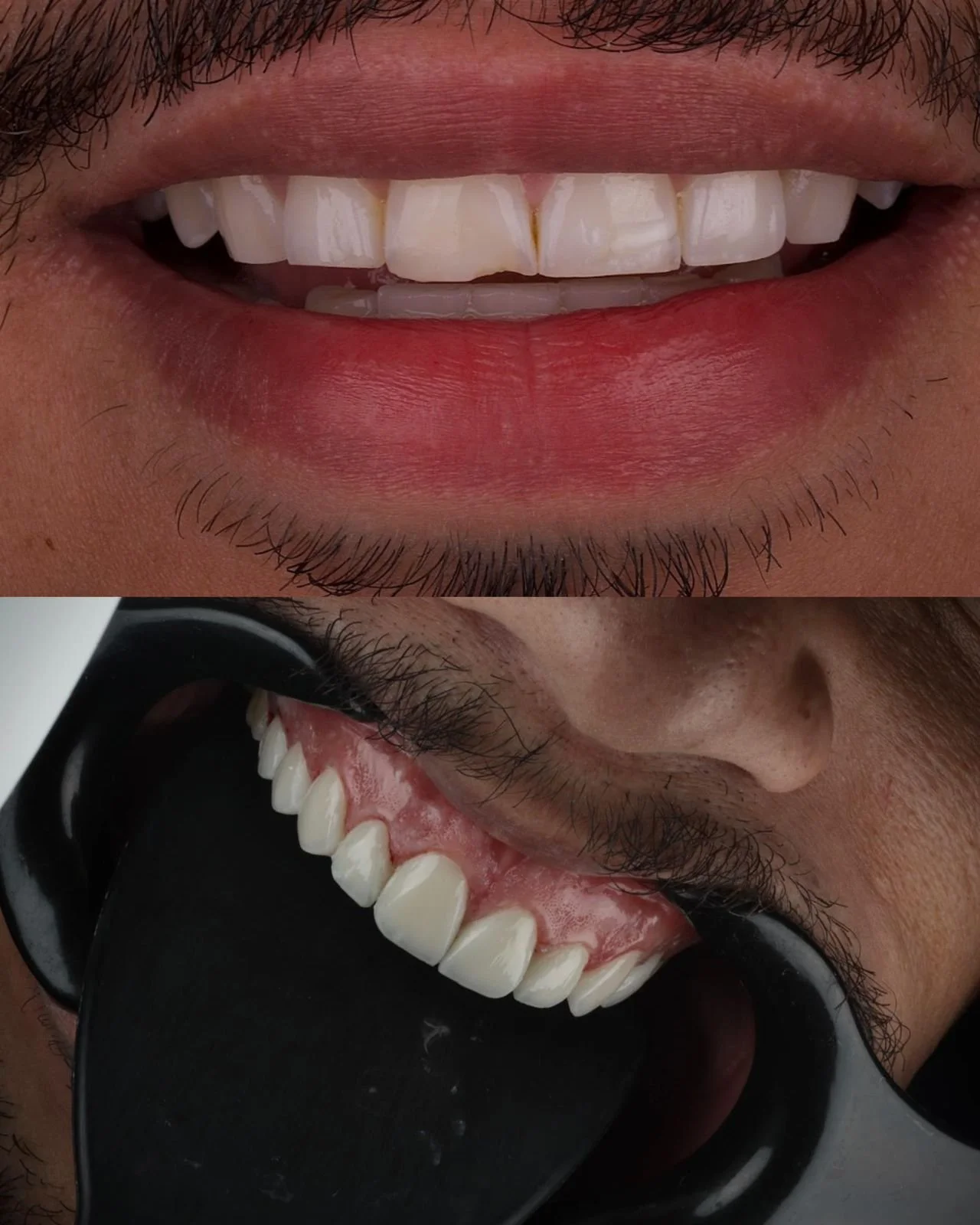Veneers Egypt .jpg