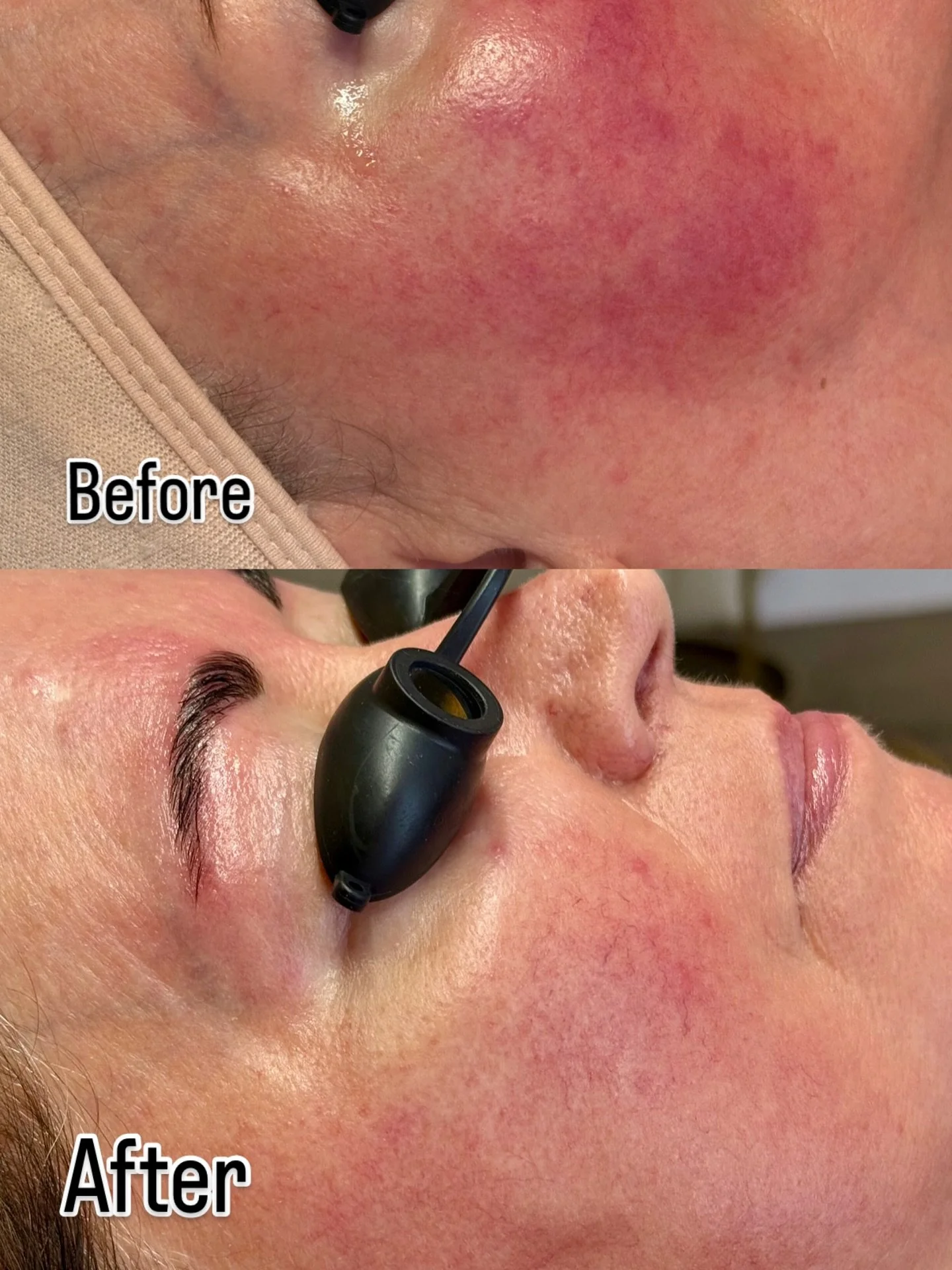 Amazing reduction of redness and inflammation! Routine monthly facials and we added in SIV Biome Balancing serum to help with barrier repair 🙌🏻 

Do you struggle with inflammation, acne, or eczema? 
.
.
.
.
#siv #skinbarrierrepair #results #tustine