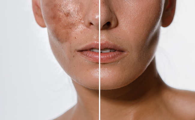 Nahaufnahme eines Gesichts, links mit Akne und Hautproblemen, rechts klare Haut.