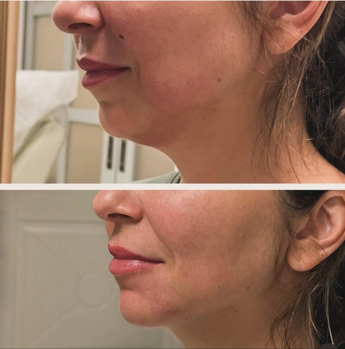 The power of a defined chin ✨

A sculpted chin doesn&rsquo;t just change your profile &mdash; it transforms how you feel.

Our patients often say they feel:
💥 More chiselled
💥 More confident
💥 More balanced
💥 Absolutely thrilled with their result