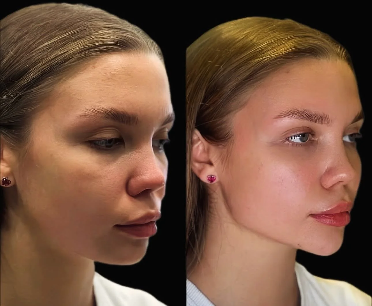 ✨ Every face holds its own beauty &mdash; my art is to enhance it so it shines from every angle. Facial harmony is all about balance, proportion, and the golden ratio. A sculpted jawline, lifted mid-face, and defined chin can bring out incredible nat