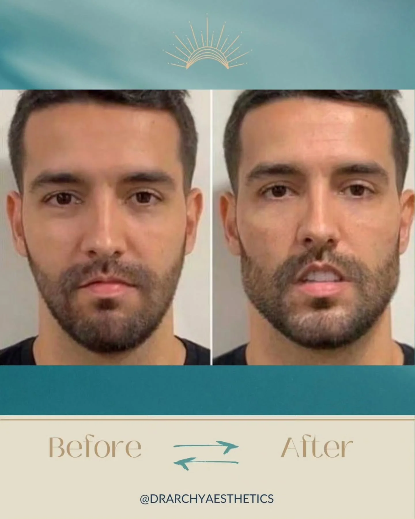 Male Aesthetics Month ⚡

Subtle. Confident. Balanced.

Male facial aesthetics isn&rsquo;t about changing who you are - it&rsquo;s about refining natural structure, restoring balance, and enhancing definition in a way that still feels authentically yo