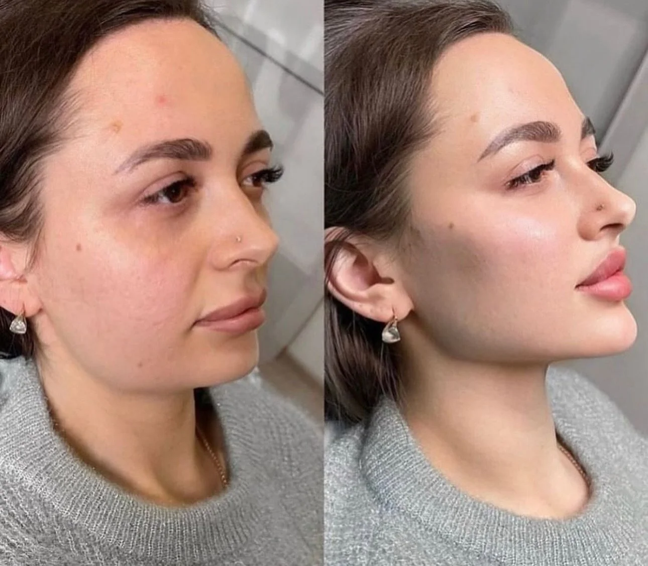 ❤️✨✨When the results are flawless and you realise the real secret ingredient was the playlist 🔥
Natural. Enhanced. Effortless. Whole face tweaks..
Guess You can take me out of India, but cannot take the Indian out of me 😊🙌✨✨