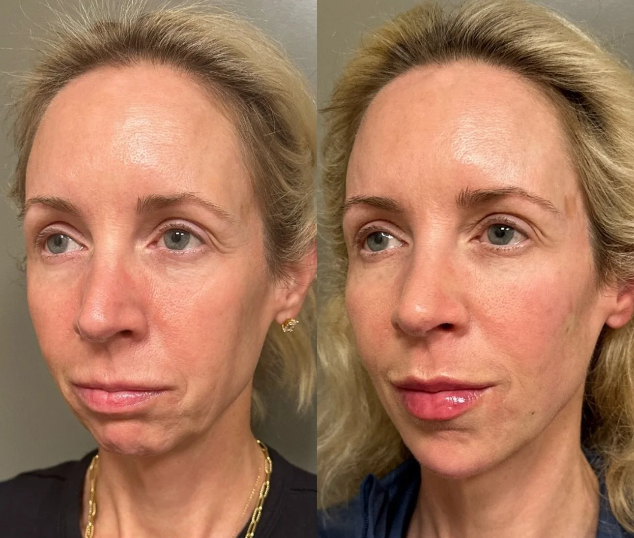 When it comes to beauty, balance &gt; perfection.
👄😊The Golden Ratio (1.618) is a mathematical harmony found in nature &mdash; and it also helps explain why certain facial features look naturally attractive.
My patient 4 weeks apart after facial sy