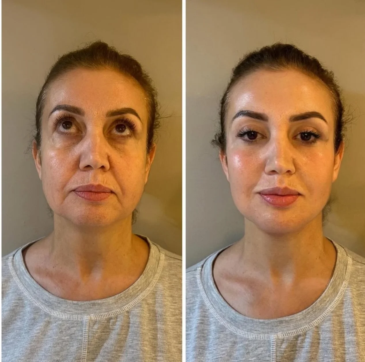 ✨ Refresh. Elevate. Glow. ✨
Step into the festive season and the new year looking like the best version of YOU. These subtle, balanced tweaks create an instantly refreshed, naturally elevated glow &mdash; because your beauty should shine effortlessly