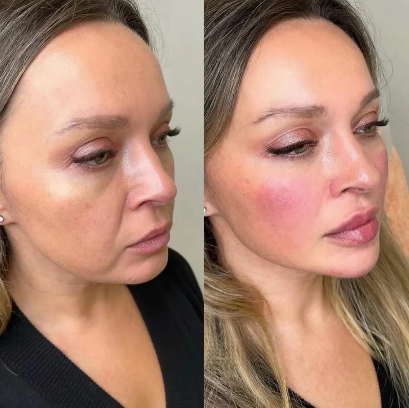 At drarchysaesthetics, with the right technique and an experienced aesthetic eye, change can be dramatic&mdash;yet healthy.
A mid and lower face refresh can age you backwards without altering who you are..
It&rsquo;s still you&hellip; just 15 years a