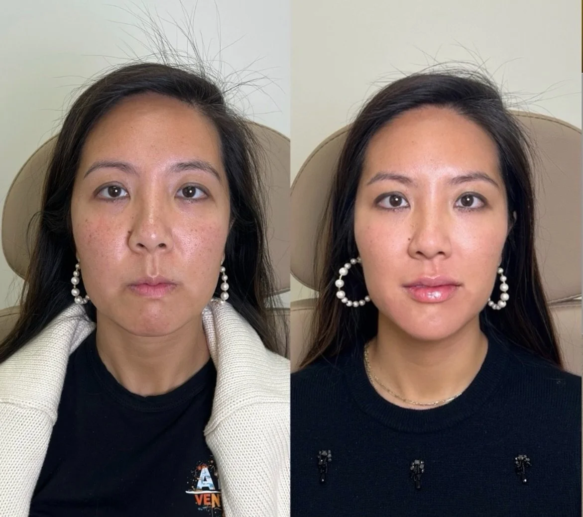 Enhancing, not altering 💉🌸🙌👄
Full-face refinement guided by Dr Archy&rsquo;s exceptional eye for detail &mdash; resulting in beautifully balanced before &amp; afters and a very happy patient.✨✨non surgical aesthetic results with no surgery and mi