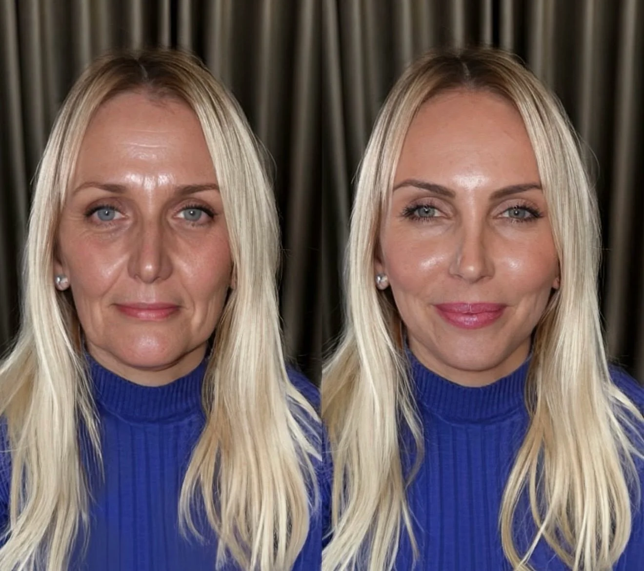 2026 is about skin health first, enhancement second.

By combining skin boosters with precisely placed dermal fillers, we create luminous, cellular-level radiance with refined facial definition.
No overfilling. No trends. Just exceptional skin.

Glow