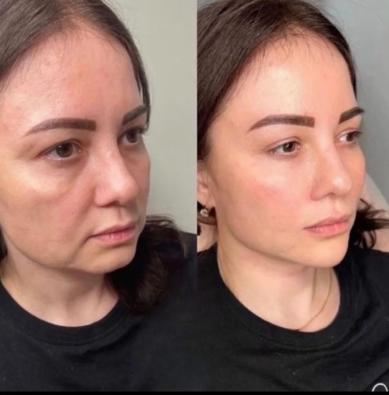 Facial balancing is never one-size-fits-all &mdash; it is an art of refinement.

True aesthetic medicine is not about changing a face. It is about honouring its structure, respecting its anatomy, and enhancing it with intention and precision.

The mi