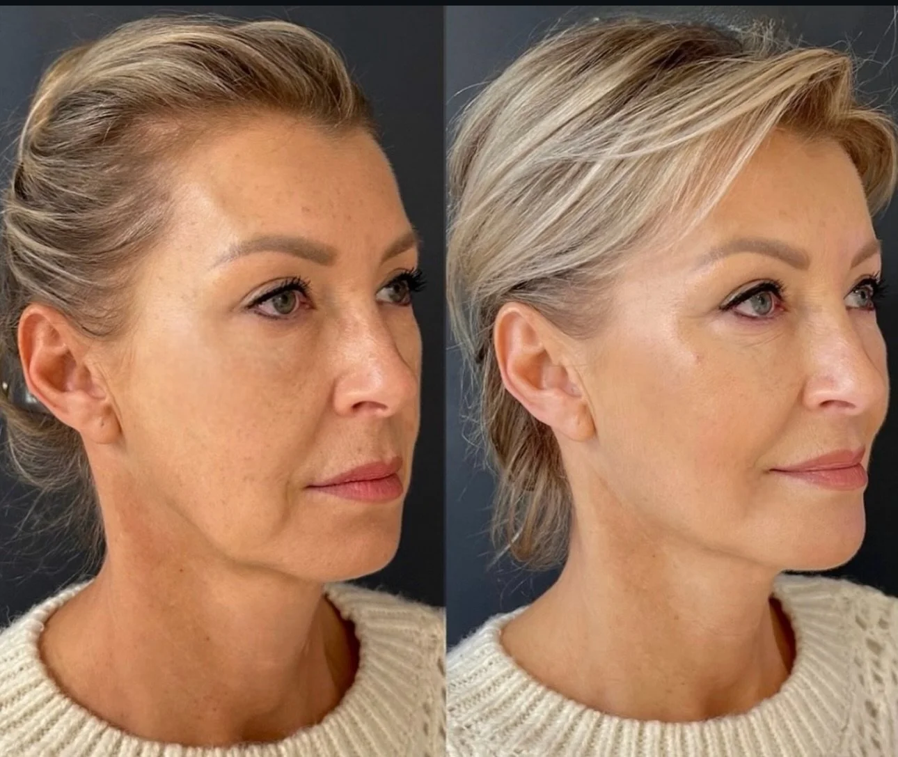 She didn&rsquo;t want to look different.
She wanted to look defined.

Treatments performed:
A beautifully balanced chin and cheek
A sculpted jawline.
A seamless pre-jowl transition.
Blended mouth to chin( marionette lines) and nose to mouth( nasolabi
