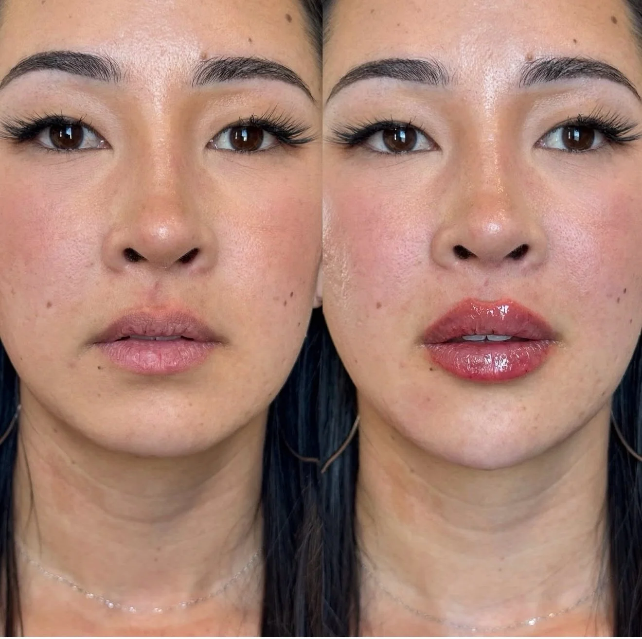 The chin sets the tone.The lips seal the deal. 💋✨

Never underestimate the power of a sculpted chin and a perfectly balanced pout. When refined with high-grade dermal fillers in expert hands, the glow-up is subtle&hellip; but the impact? Unmatched.
