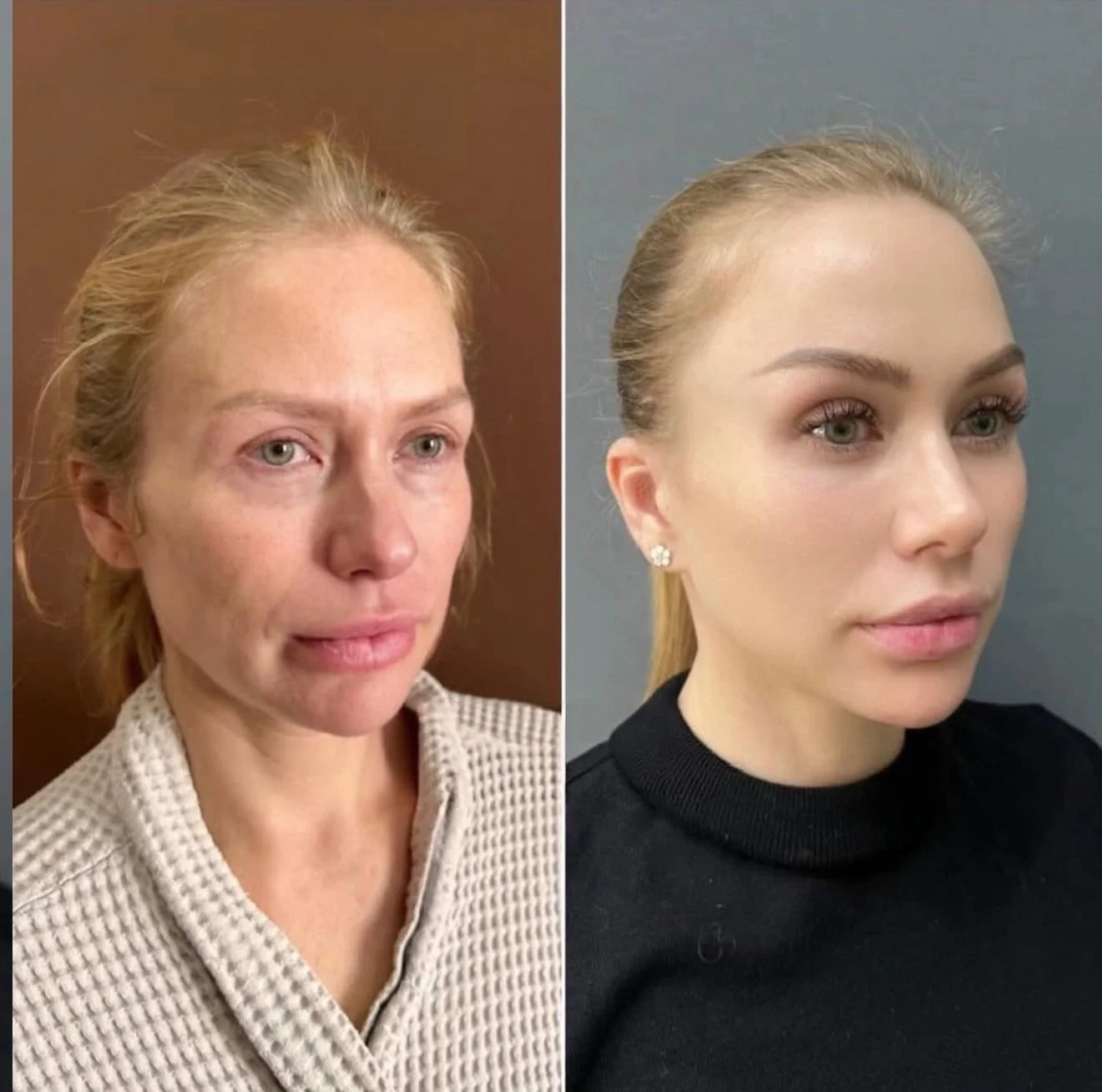 Combination of medical-grade skincare, dermal fillers for volume restoration, anti-wrinkle treatments and skin boosters can create incredible transformations over the course of a year ✨

It may sound like a lot of treatments, but healthy, glowing ski