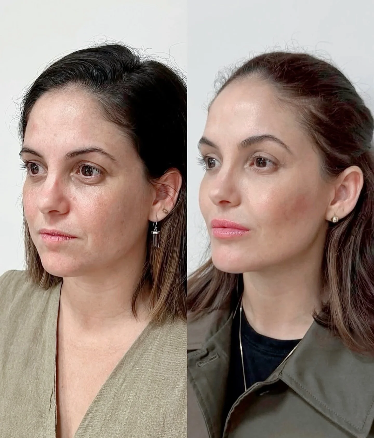 Dermal fillers can be used to subtly refine and lift, helping you look naturally refreshed without changing what makes you you. ✨

At @drarchysaesthetics, it&rsquo;s never about doing more &mdash; it&rsquo;s about doing less, but achieving results th