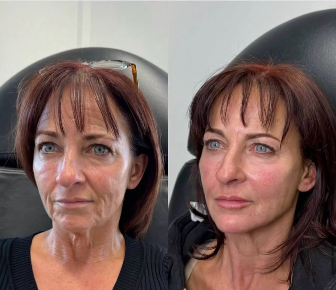 Full Face Contour ✨

Every face tells a unique story &mdash; and every treatment should be just as individual.

This beautiful transformation focused on enhancing natural balance and restoring youthful harmony. By carefully treating the mid-face, che
