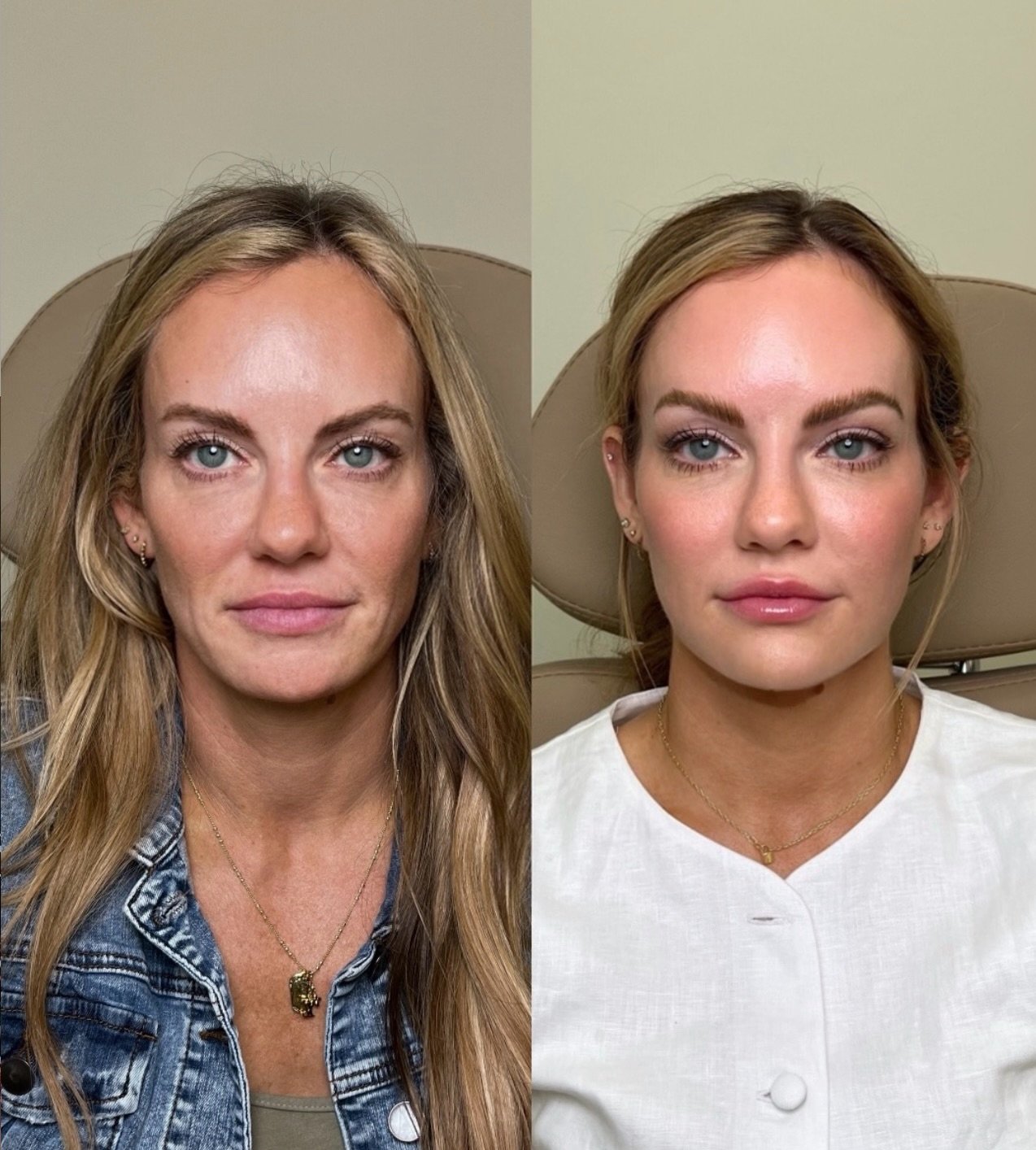 Refinement, not reinvention. 🙌✨✨

Facial balancing is an art of subtlety &mdash; where features are gently softened, proportions are harmonized, and natural beauty is elevated with intention.

This full-face liquid facelift reveals a graceful transf
