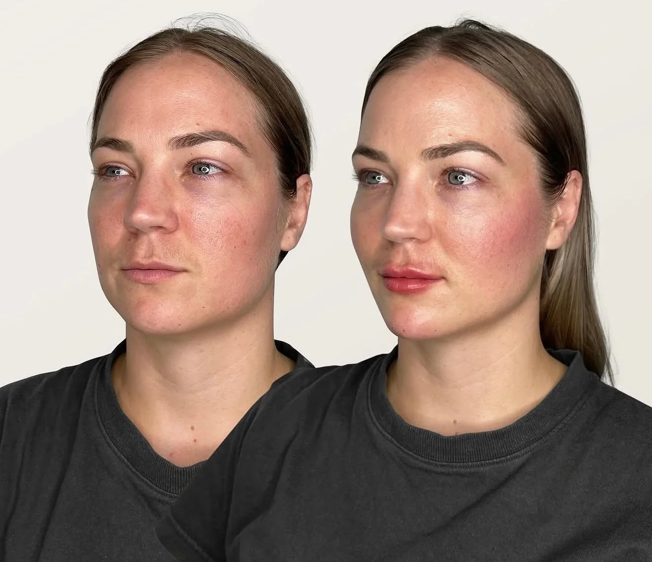 A little flat? A little tired? We don&rsquo;t do &ldquo;overdone&rdquo; here&mdash;we do refined, lifted, and quietly powerful.

Strategically placed dermal filler, guided by true anatomical expertise, restores structure, enhances contour, and brings