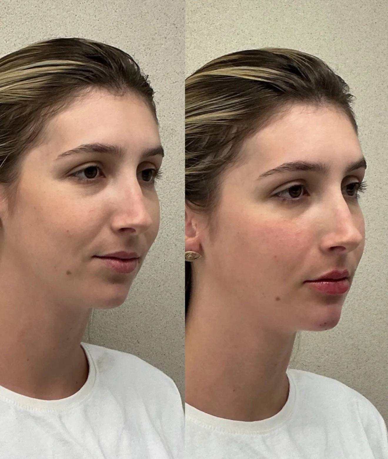 A little tweak, a lot of attitude 💋✨

Snatched chin, smoother lips, subtle cheek enhancements and those nose-to-mouth lines? Softened like they never stood a chance.

Still you&mdash;just fresher, sharper, and serving confidence from every angle.

B