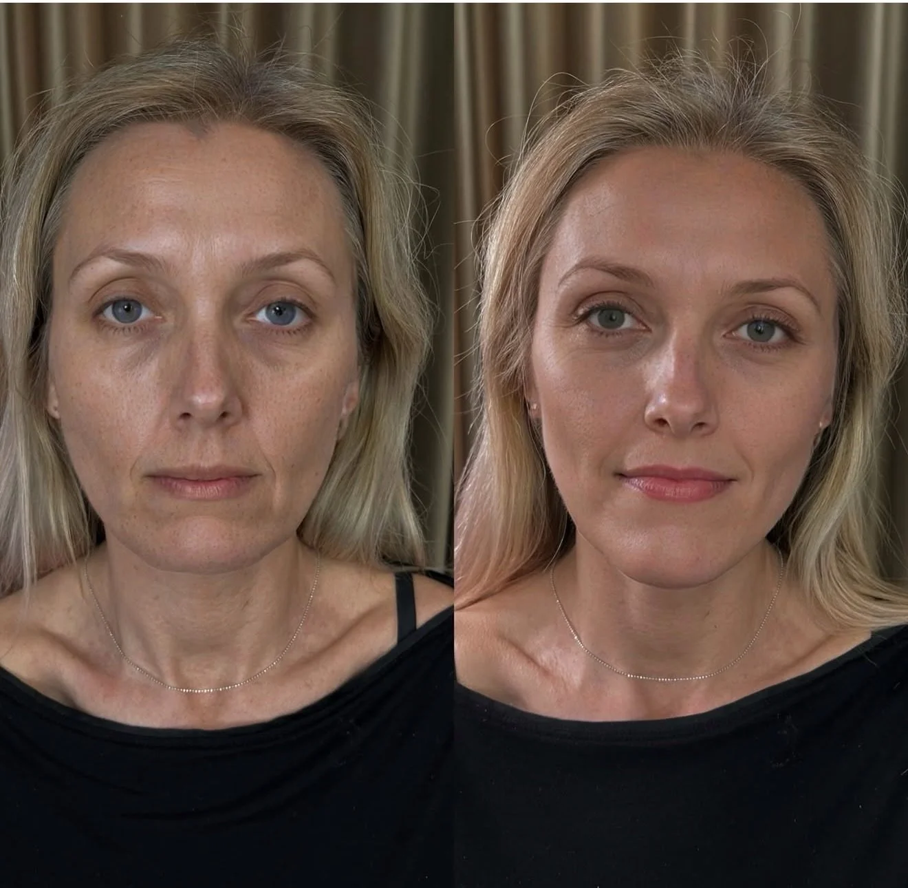 GLP-1 weight loss can transform the body&hellip; but the face often loses volume and structure.

This is where precision matters ✨

For this patient, we restored balance&mdash;lifting the midface, refining contours, and bringing back soft, natural de