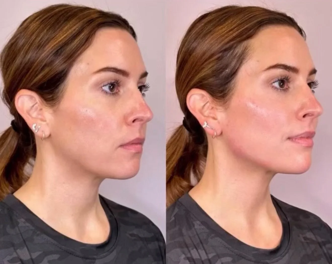 A little tweak here, a little sculpt there&hellip; who said subtle can&rsquo;t steal the spotlight? ✨

Mid-face lifted, cheeks softly snatched, chin refined, jawline on quiet luxury mode.

No drama, no overfilling &mdash; just that &ldquo;you look am