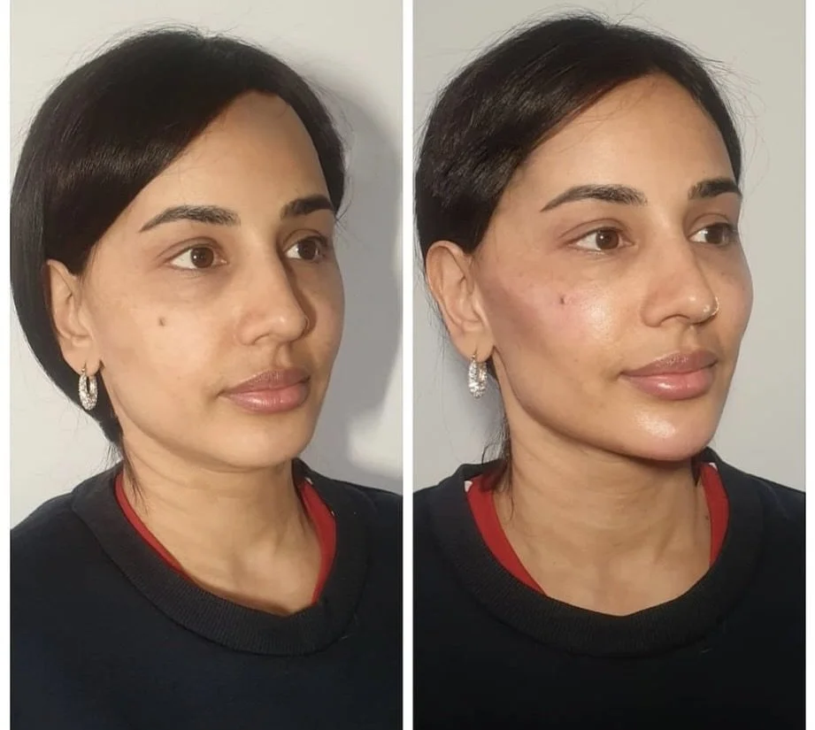 Refinement, redefined ✨

A full-face transformation curated with intention &mdash; nose, cheeks, midface, chin, softly enhanced lips, and a sculpted jawline.

Every detail considered. Every feature in harmony.

Following an in-depth consultation and 