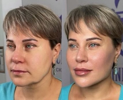 ✨ Facial balancing + lower face contouring with dermal fillers, paired with skin boosters = sculpted features + glowing, glass-like skin.

Subtle enhancements. Luxury results.
Classy. Sassy. Effortlessly flawless. 💎✨ Book your consultation to make a