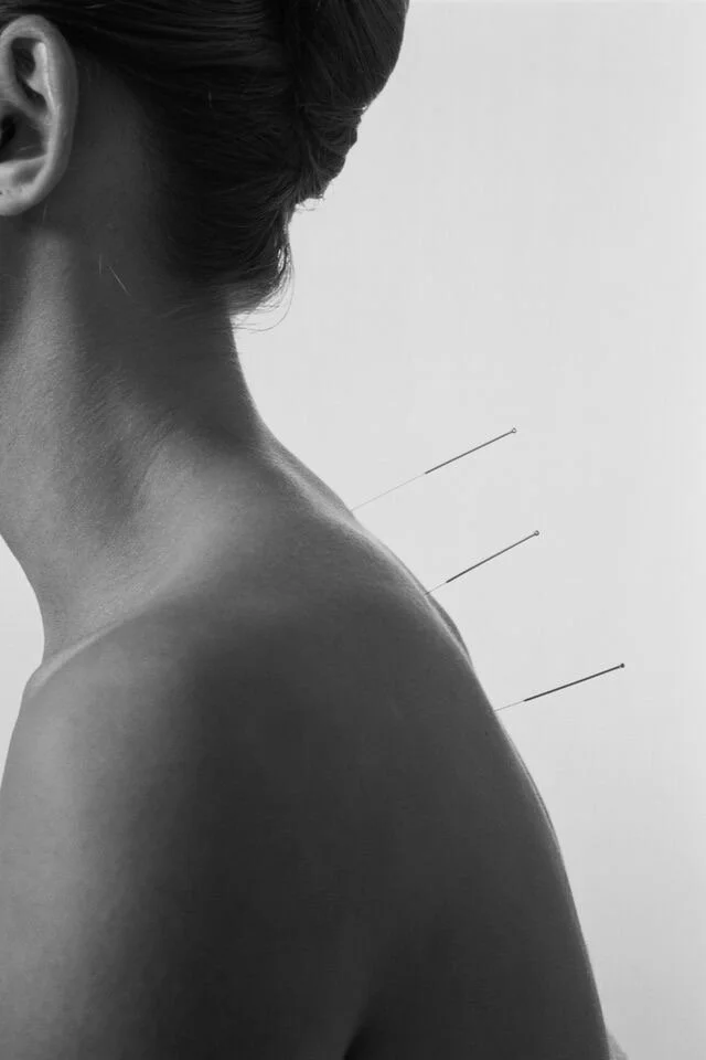 Side view of a woman's upper body, showing her neck, shoulder, and part of her face with dark hair tied back, against a plain background with three acupuncture needles inserted into her shoulder area.