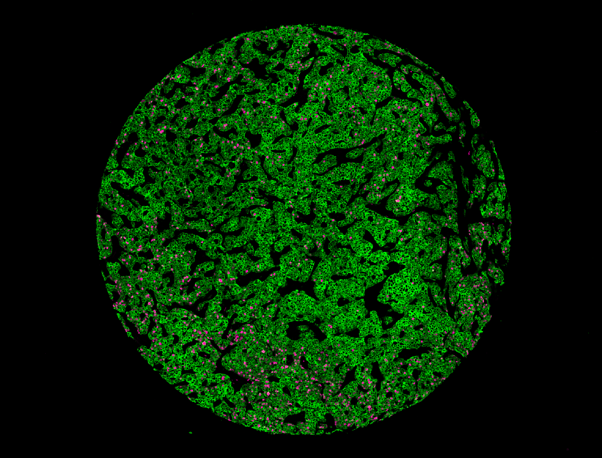 Breast Cancer: Pan-CK, CD45