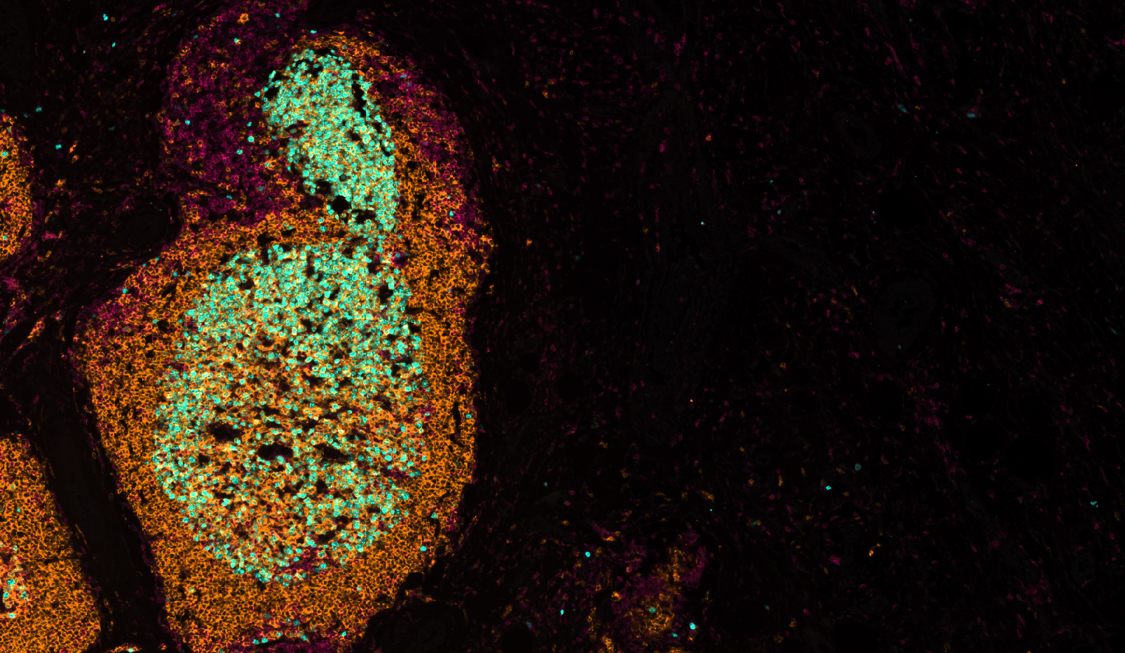 Melanoma TLS: Ki-67