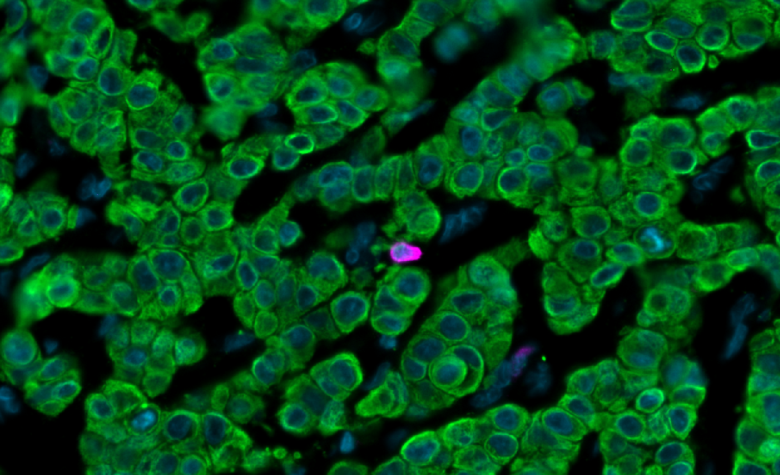 Microscopic view of green, circular cells with blue nuclei and a single purple-stained cell among them.