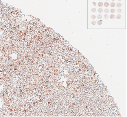 Microscopic view of a tissue sample stained to highlight cell nuclei, with a smaller inset showing a grid of similar stained samples.