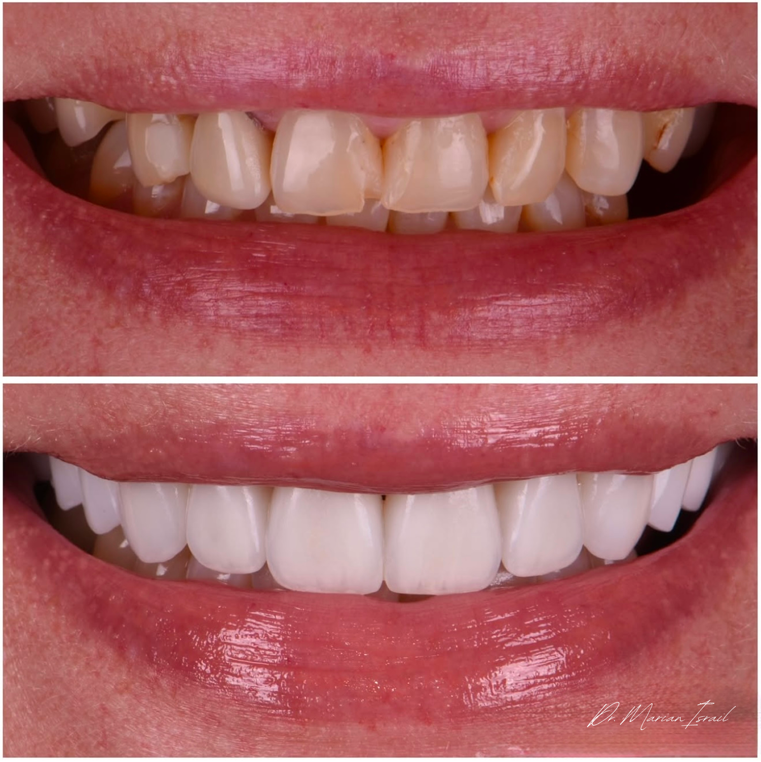 Comparison of teeth before and after dental whitening. The top shows stained teeth with visible discoloration, while the bottom shows bright, white teeth after whitening treatment.