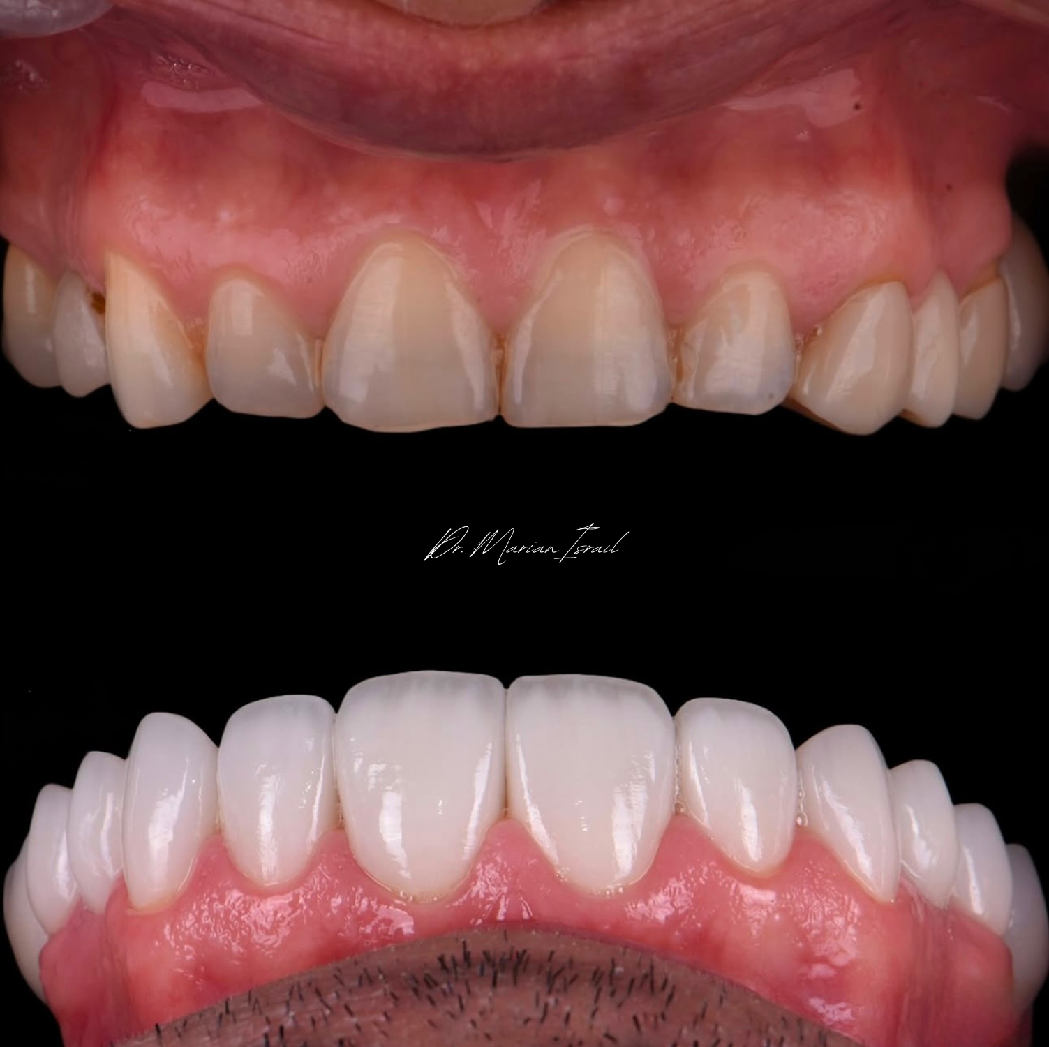 A before and after comparison of a person's teeth showing significant improvement in tooth alignment and color. The top image displays stained, crooked teeth, while the bottom image shows straight, white teeth.
