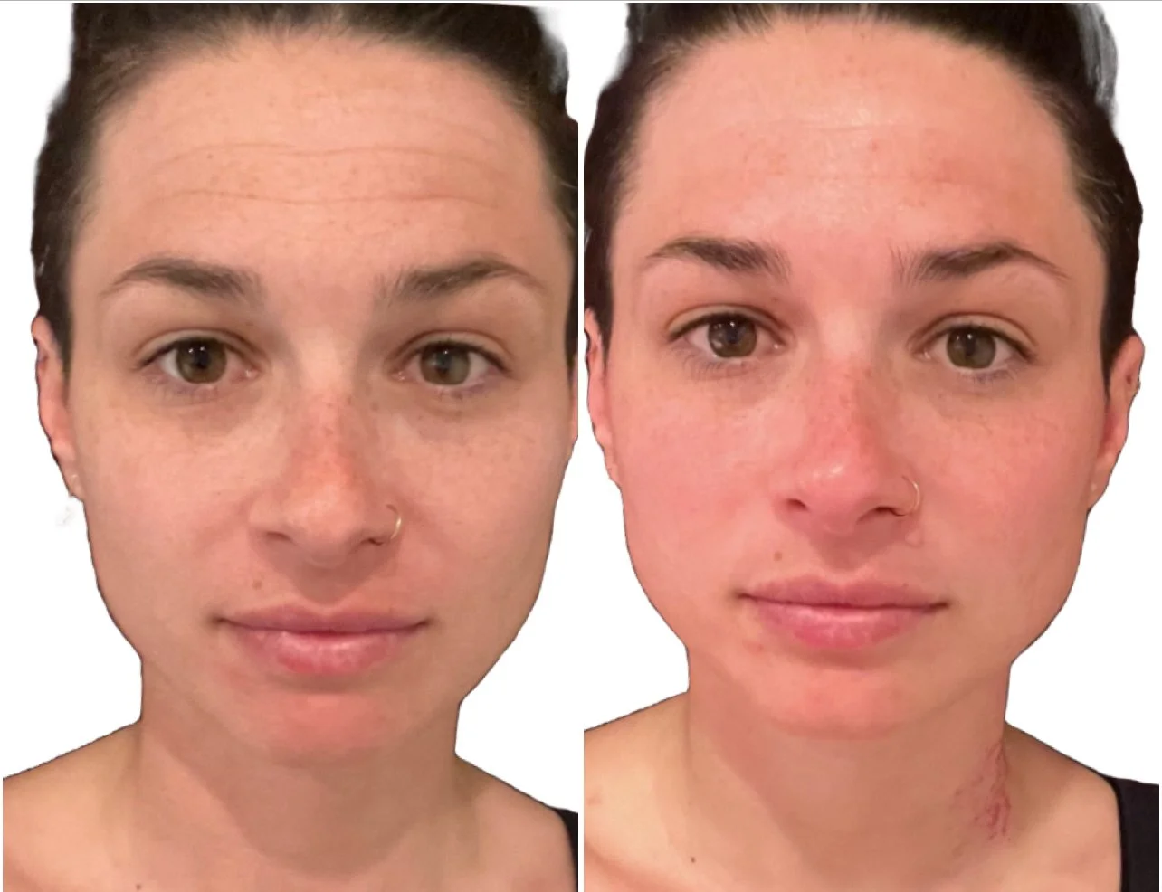 Side-by-side comparison of a woman's face before and after skincare, showing reduced redness and clearer skin in the after photo.