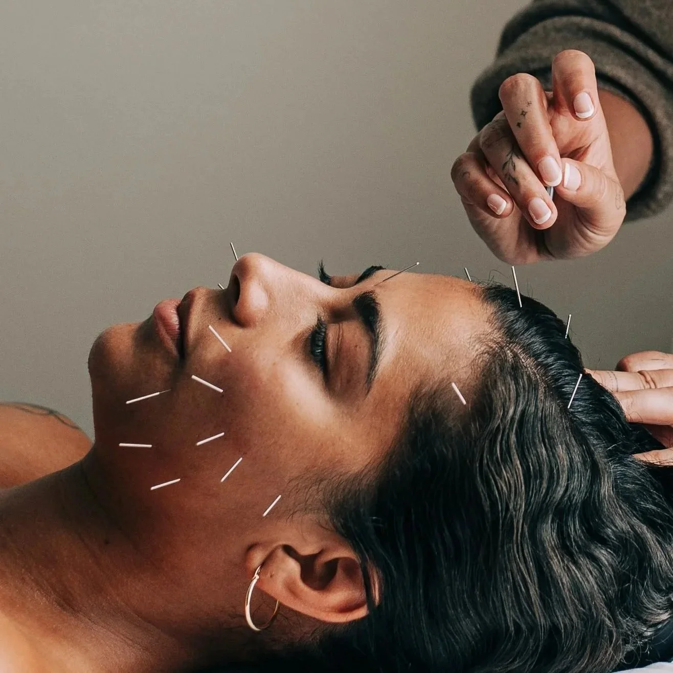 Facial Rejuvenation Acupuncture